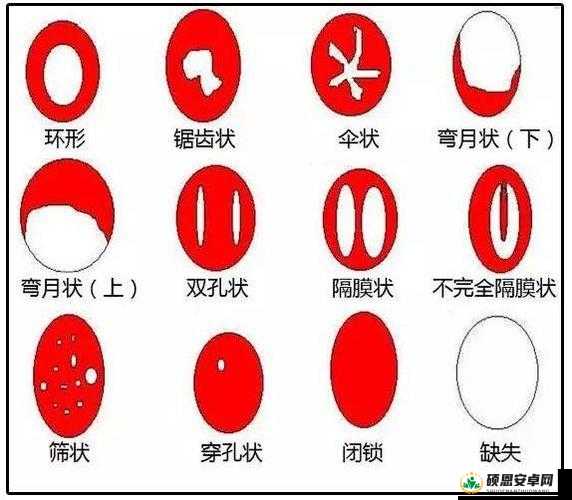 图示蝴蝶：揭示阴脣肥大的真相